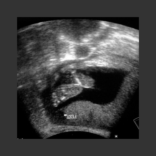 A sonogram of the baby boy's feet . This image is a screen shot that was printed out on paper, and then digitally scanned. 